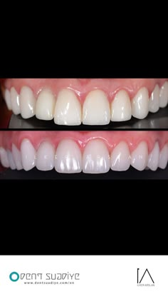 Teeth Vision Board, Perfect Smile Teeth, Veneers Teeth, Dental Work, Teeth Shape, T Design, Dental Veneers