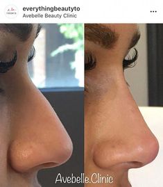 Noses For Nose Jobs, Saddle Nose Deformity, Nose Inspo Rhinoplasty, Nose Tip Filler, Rynoplasty Surgery, Dorsal Hump Rhinoplasty, Turkey Nose Job, Nose Inspiration Rhinoplasty