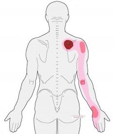 Trigger Points Neck, Therapist Notes, Swollen Hands, Sore Shoulder, Referred Pain, Stiff Neck, Psoas Muscle, Trigger Point, Neck And Shoulder Pain