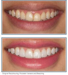 Veneer Teeth, Cosmetic Dentistry Veneers, Dental Aesthetics, False Teeth, Beautiful Teeth