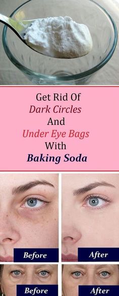 Eye bags: 1. Add 1 teaspoon of backing soda in a glass of hot water or tea and mix it well. 2. Take a pair of cotton pads and soak them in the solution and place them under the eye. 3. Let it sit for 10-15 minutes, then rinse it off and apply a moisturizer Practicing this procedure daily will render amazing results in just a week.: Remove Dark Circles, Under Eye Bags, Beauty Remedies, روتين العناية بالبشرة, Skin Remedies, Eye Bags, Face Skin Care, Homemade Beauty Products