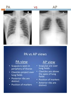 an x - ray shows the chest and ribs in different stages of development, including pa versus