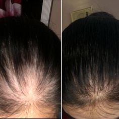 Hair Regrowth Before And After, Hair Growth Before And After, Hair Before And After, Before And After Hair Growth, Slow Hair Growth, Hair Growth Challenge, Healthy Natural Hair Growth, Thicker Fuller Hair, Dramatic Hair