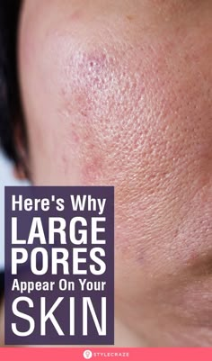 Poreless Skin, Big Pores, Forehead Acne, Face Pores, Smaller Pores, Natural Face Skin Care, Reduce Pores, Skin Care Wrinkles, Makeup Mistakes