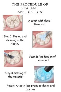 Dental Template, Registered Dental Assistant, Dental Assistant School, Hygiene School, Childrens Dental Health, Dental Sealants, Dental Hygiene Student, Dental Assisting