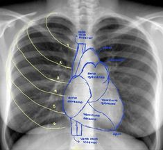 an x - ray shows the location of the heart in the chest