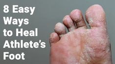 Athlete’s foot is a contagious fungal infection that arises when the tinea fungus grows on the feet. Here are easy ways to heal athlete's foot: | Foot Fungus Remedies, Nail Remedies, Natural Antifungal, Ways To Heal, Fungal Nail, Athletes Foot, Foot Soak, Peeling Skin, Fungal Infection Foot Fungus Remedies, Natural Antifungal, Ways To Heal, Athletes Foot, Foot Soak, Fungal Infection