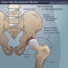 Hip Injury, Hip Anatomy, Hip Injuries, Hip Problems