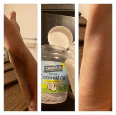 two pictures showing the different stages of varicous on someone's arm and foot