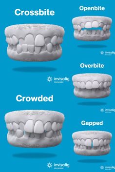 Dental Charting, Dental World, Teeth Alignment, Remedies For Tooth Ache, Dental Health Care