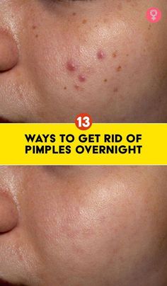 Pimples can make you feel less confident and take a toll on you mentally. But why worry when you can get rid of pimples with simple remedies. Check them out now! Zit Remedy, Redness Pimple, Blind Pimple, Get Rid Of Pimples, Rid Of Pimples