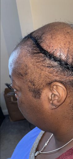 The Only Natural CCCA Alopecia Treatment & Hair Growth Solutions– BlackHairandSkincare Alopecia Diet, Alopecia Hair Growth, Alopecia Hairstyles, Diet Schedule, Grease Hairstyles, Shaved Hair Designs, Hair Regrowth Treatments, Hair Growth Serum