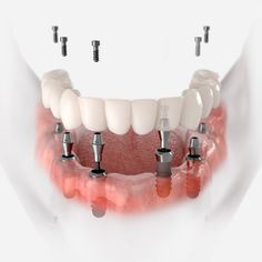 Dentistry Design, Dental Wall Art, Dental Images, Dental Videos, Medical Animation, Dental Fun, 99 Percent, Straight Teeth