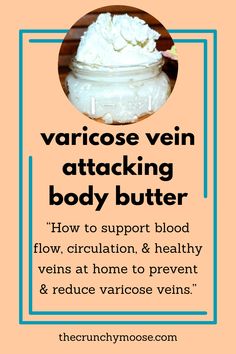 Varicose vein attacking body butter, get rid of varicose veins naturally with essential oils Natural Spider Vein Remedies, How To Get Rid Of Vericous Veins, How To Get Rid Of Varicose Veins, Vericous Veins, Healthy Veins, Varicose Veins Essential Oils, Vein Health, Varicose Vein Remedy, Homemade Body Care