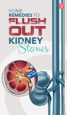 Help Passing A Kidney Stone, What To Eat For Kidney Health, Kidney Stone Natural Remedy, How To Remove Stones From Kidney, Kidney Remedies Natural, Natural Remedies For Kidney Stone Pain, Kidney Stone Cleanse, Kidneystone Natural Remedies, How To Break Up A Kidney Stone