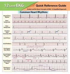 Cardiac Step Down Unit, Ekg Interpretation, Nurse Teaching, Medical Laboratory Technician, New Grad Nurse, Nursing School Essential, Nursing Study Guide, Nurse Study Notes, Nursing Student Tips