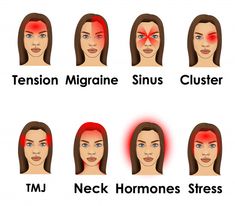 Types Of Headache, Tension Migraine, Natural Headache, Headache Types, Natural Headache Remedies, Biology Facts, Migraine Relief, Health And Fitness Articles, Headache Relief