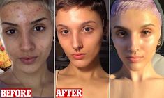 Woman shares before-and-after transformation of skin and reveals the regime that got rid of acne Before And After Acne, Apple Cider Vinegar Acne, Get Rid Of Acne, Rid Of Acne, Types Of Acne, Parts Of The Body, Acne Breakout, How To Get Rid Of Acne