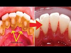 Baking Soda Teeth, Baking Soda Teeth Whitening, Going To The Dentist, Teeth Whitening Homemade, Makeup Life Hacks, Kedokteran Gigi, Teeth Whitening Remedies, Teeth Whitening Diy, Dental Plaque