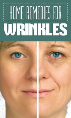 Cute Parents, Wrinkles Under Eyes, Home Remedies For Wrinkles, Hide Wrinkles, Wrinkle Remedies, Home Remedies For Acne, Under Eye Wrinkles