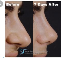 Bulbous Tip Rhinoplasty, Small Nose