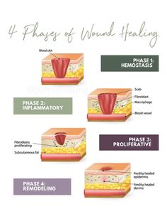 the four stages of wound - healing and how to use it in this article