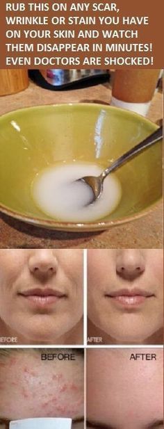 Natural Cold Remedies, Natural Cough Remedies, Peinados Fáciles Para Cabello Corto, Wrinkle Cream, Natural Home Remedies, Face Skin Care