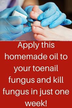 World renowned fungus expert Dr. Langdon has discovered that the source of skin and toenail fungus infections may have not be external, but… | Toenail Health, Toenail Fungal Infection, Toenail Fungus Remedies, Nail Infection, Fungal Nail, Homemade Oil, Ingrown Toe Nail, Nail Oil, Toenail Fungus Homemade Oil