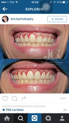 Odontologia Gum Laser Surgery Before And After, Crown Lengthening Before And After, Crown Lengthening, Dental Makeover, Dental Images, Dental World, Dental Aesthetics, Kedokteran Gigi, Dental Anatomy