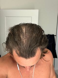 Michael | Chronic Pain Coach on X: "How I Saved My Hair From the Brink of Destruction: (Without pharmaceuticals) I took these pictures 8 months apart from one-another. TLDR: ‣ Natural Shampoo ‣ Rosemary/Lavender Growth Oil ‣ Shower Filter ‣ Egg Masks ‣ Scalp Massages ‣ Sunlight/Red Light Therapy I took… https://t.co/h2RwOTAxWr" / X