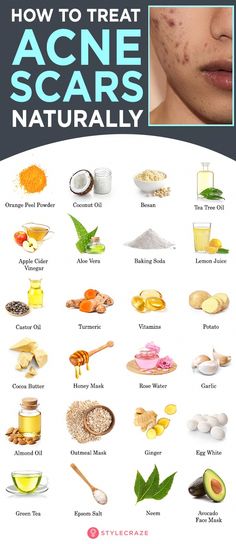 Natural remedies are an effective alternative to surgery or harsh techniques for treating acne scars. These 12 remedies can help lighten your scars gently. Skin Care For Acne, Baking Soda Lemon Juice, Baking Soda And Lemon, Turmeric Vitamins, Get Rid Of Acne, Rid Of Acne, Home Remedies For Acne