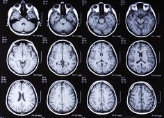 multiple mri images show the different areas of the brain, including one with an abnormally large area