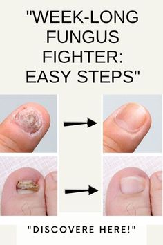 | Nail Ideas Gel, Ugly Toenails, Fungal Infection Remedies, Aloe Vera For Sunburn, Home Remedies For Allergies, Natural Remedies For Migraines, Nail Problems, Fungal Nail, Dry Skin Remedies Nail Fungus Remedy, Nails Today, How To Grow Nails, Healthier Skin, Nail Oil