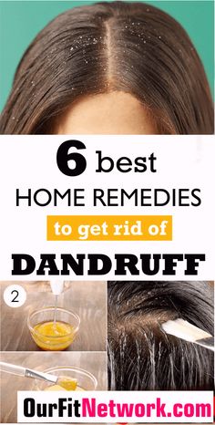 6 Best Home Remedies To Get Rid Of Dandruff For Good #remediesagainsthairloss How To Remove Dandruff, Natural Dandruff Remedy, Hair Mask For Dandruff, Dandruff Solutions, Home Remedies For Dandruff, Rid Of Dandruff, Dandruff Remedy, Getting Rid Of Dandruff, Hair Dandruff