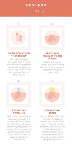 Popping a zit probably isn't the best thing for your skin, but if you're going to do it anyway, learn how to do it the right way first Popping Pimples, Pimples On Buttocks, Pimples On Forehead, Acne Soap, Pimples Remedies, Under The Skin