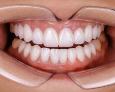 Beautiful Smile Aesthetic, Dental Morphology, Smile Aesthetic, Pretty Teeth, Veneers Teeth, Healthy Gums, Aesthetic Dentistry, Perfect Teeth, Teeth Shape