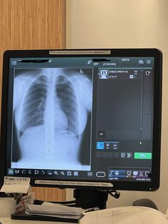 an x - ray image is displayed on a computer screen in front of a monitor