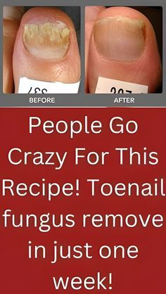 Toe Nail Fungal Infection, Fungal Infection Remedies, Creepy Skin, Diy Haircare