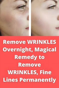 6 Natural Remedies for Wrinkles to Make You Look Younger Forehead Wrinkles, Remove Dark Spots, Anti Aging Tips, Prevent Wrinkles, Sagging Skin