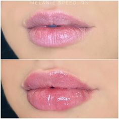 Bottom Lip Filler, Overfilled Lips, Lips Fillers, Lip Combos, Lip Augmentation, Lip Enhancement, Bottom Lip, Perfect Lips