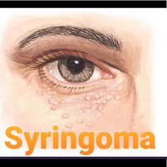 What Is Syringoma? Syringoma Is A Non-Cancerous (Benign) Bump, Usually Found On The Upper Cheeks And Lower Eyelids Of Young Adults. Syringomas Are Caused By The Overgrowth Of Cells From Sweat Glands (Eccrine Glands). Syringomas Are Small Papules, Or Firm Bumps, That Are About 1 To 3 Millimeters Wide. The Papules Usually Grow In Small Groups And Are Typically: Syringomas Can Be Caused By Any Activity That Increases Sweat Gland Productivity, Which May Lead To Tumor Growth. Fourth Of July Quotes, Blackhead Remover Diy, Lighten Scars, Skin Moles, Face Tips, Home Remedies For Acne, Sweat Gland, Seal Beach, Acne Remedies