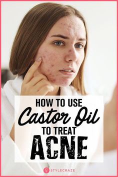 Acne is such a pain in your you-know-what. Fret not, as I would suggest you to consider using castor oil for acne. Here is how to use it & everything about Castor Oil For Acne, Skincare Acne, Acne Face Mask, Acne Oil, Skin Cleanser, How To Get Rid Of Pimples