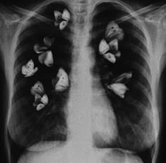 an x - ray shows the chest and lungs