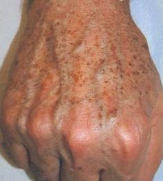 Bleaching Cream, Brown Spots, Health And Beauty Tips, Beauty Treatments, Belleza Natural, Health Remedies, Beauty Secrets, Beauty Care, Home Remedies