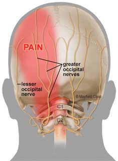 Nerve Block Injection, Occipital Nerve Block, Nerve Anatomy, Occipital Neuralgia, Head Pain, Nerve Pain Relief, Chronic Migraines