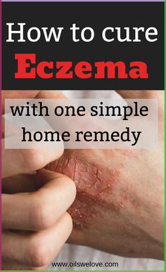 How to cure eczema naturally with this simple DIY home remedy. Heal your #eczema easily with this one-ingredient  diyd homemade eczema treatment. #remedy Home Remedies For Warts, Warts Remedy, Asthma Remedies, Rogue Fitness, Skin Disorders, Chiropractic Care, Skin Remedies, Manuka Honey, Yoga Sequences