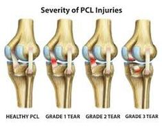 PCL injury Acl Surgery Recovery, Anterior Cruciate Ligament, Knee Ligaments, Acl Surgery, Straight Leg Raise, Ligament Tear, Acl Tear, Cruciate Ligament, Ligament Injury