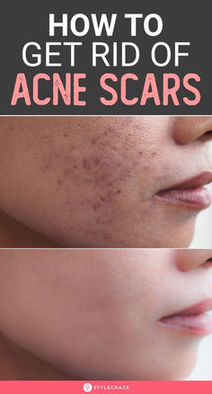 How To Get Rid Of Acne Redness Fast, Best Home Remedy For Acne Scar, How To Get Rid Of Face Acne, For Acne Remedies, Acne Spot Removal, How To Lighten Acne Marks, Face Acne Scar Removal, Pock Marks Remedy, How To Get Rid Of Pimples Marks