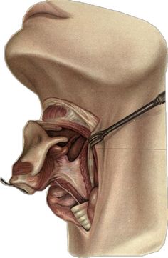 an image of a cross section of the head and neck with surgery tools attached to it