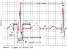 Ekg Tech, Ekg Interpretation, Nurse Jackie, Radiology Technologist, Heart Blocks